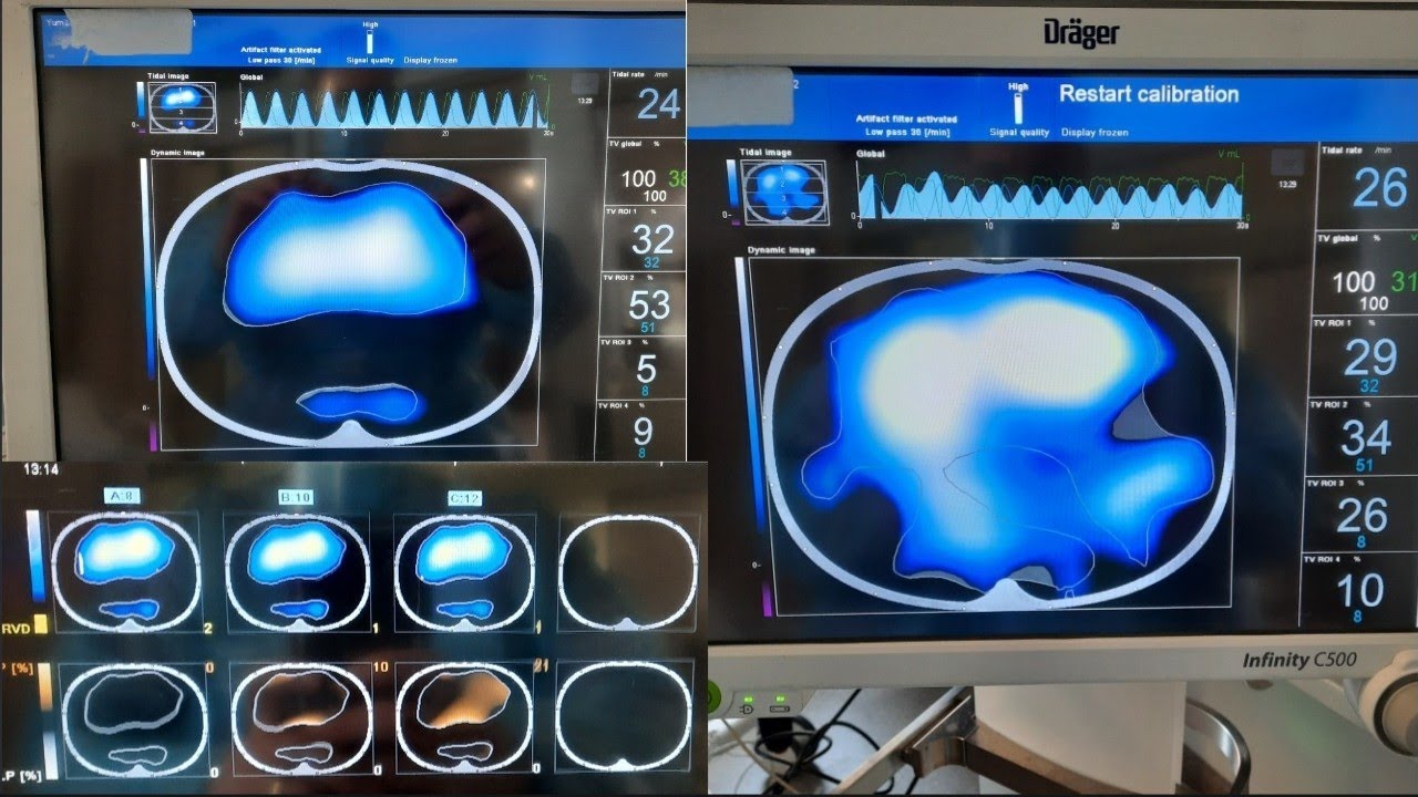 CASE STUDY // ACVC compared to APRV to recruit mid-dorsal region