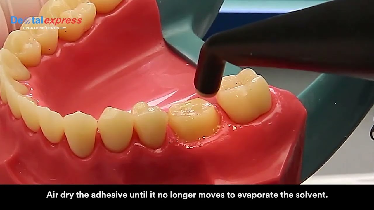 3M™ RelyX™ Ultimate Adhesive Resin Cement Application Video - DENTALEXPRESS