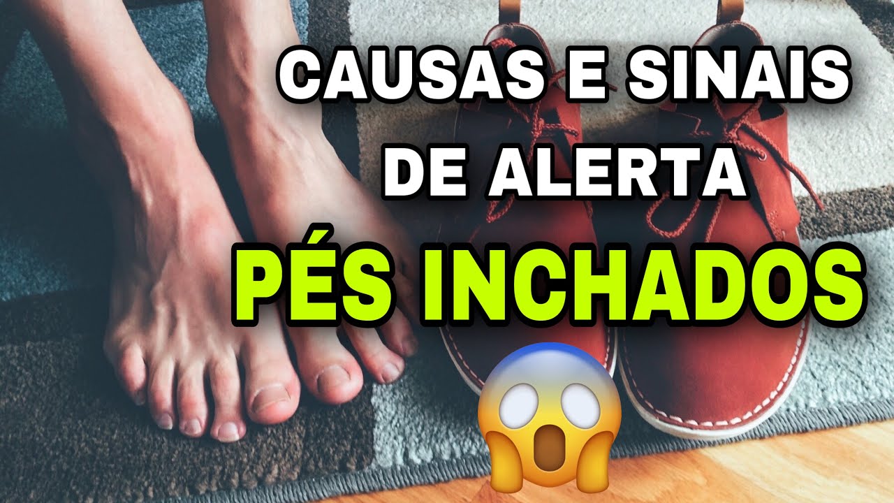 10 Causas de Pernas e Pés inchados e Sinais de ALERTA 🚨