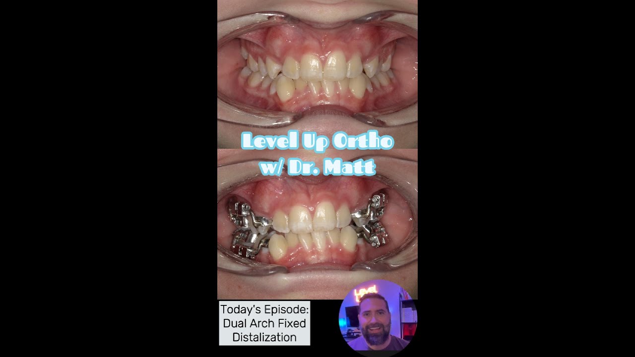 Dual Arch Distalization!  Level Up Ortho chat w/ Dr. Matt