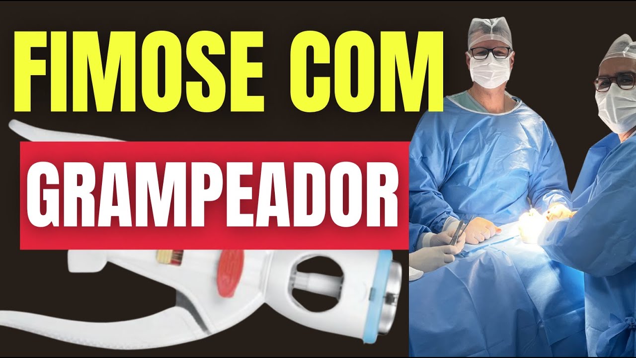 Grampeador de FIMOSE COM ANASTOMAT: O passo a passo. T&eacute;cnica que est&aacute; Revolucionando a Circuncis&atilde;o