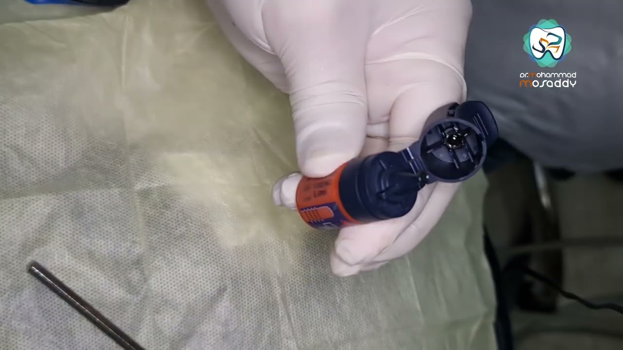 طريقة البوندينغ و الايتشينغ الكامل total etch   wet bonding