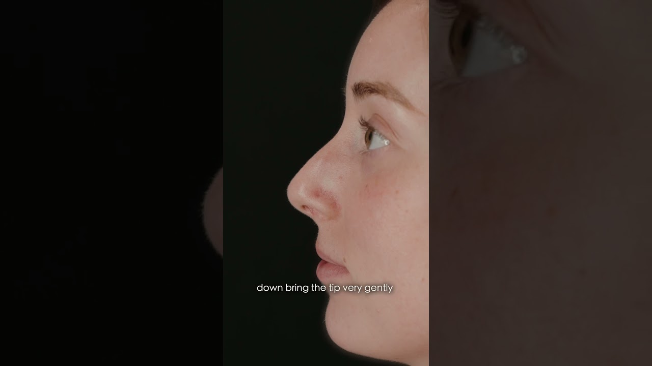 Rhinoplasty Unique Approach ✨