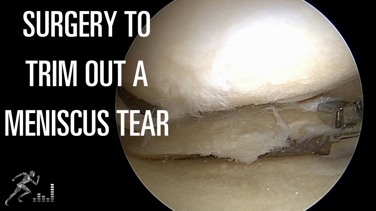 Meniscus tear: Partial meniscectomy, or surgery to trim out the tear