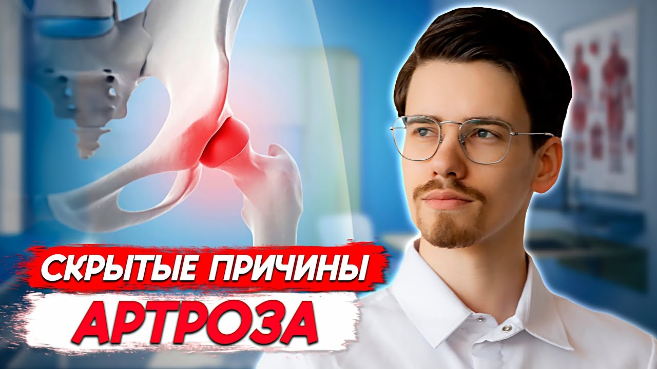 КОКСАРТРОЗ. Лечение артроза тазобедренного сустава. P-DTR