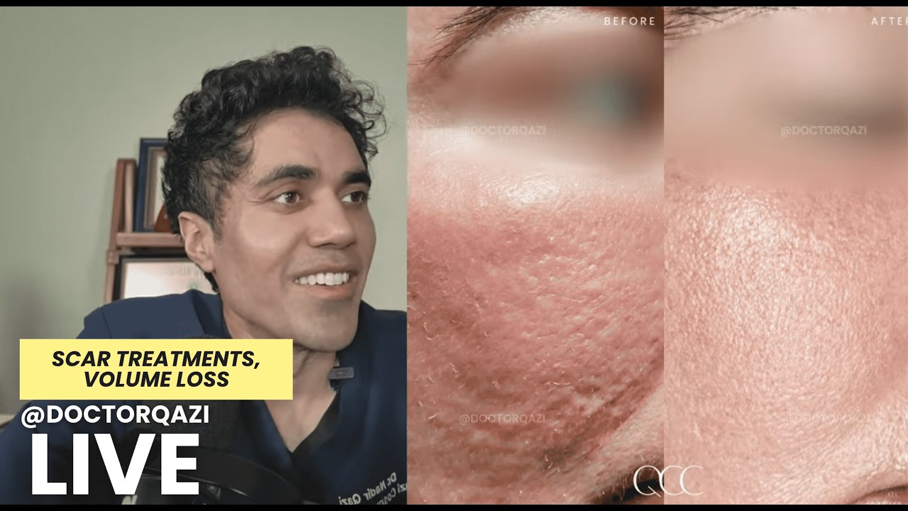 Dr. Qazi discusses Scar Treatments & More | Dr. Qazi Unsponsored Live | 2.3.2026