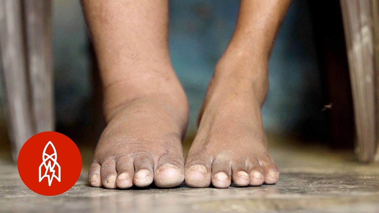 Racing to End Elephantiasis in India