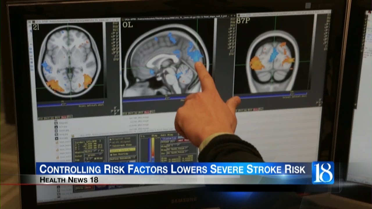 Health News 18: Controlling Risk Factors Lowers Severe Stroke Risk
