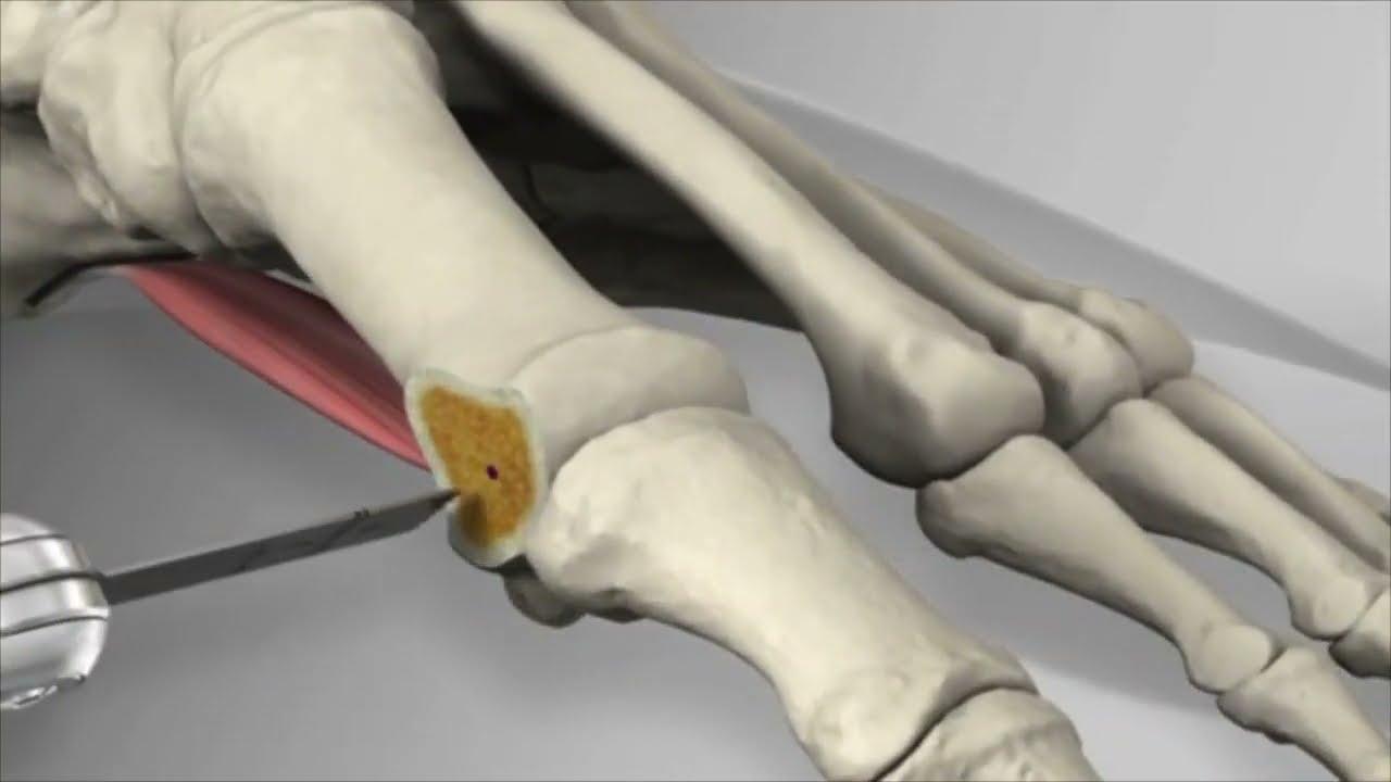 Hallux valgus d&eacute;viation du gros orteil - Chirurgie de correction Scarf - Dr Simon Tournemine