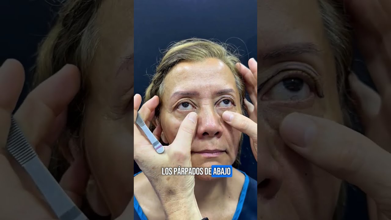 PINCH BLEPHAROPLASTY