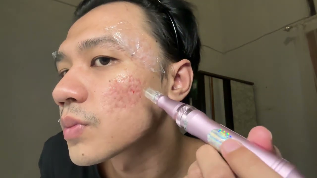 DERMAPEN ZONK 😭 #anastesiGaMempan
