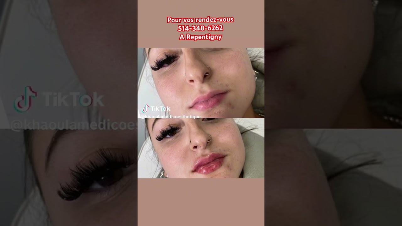 belles lèvres faites à la clinique khaoula 
