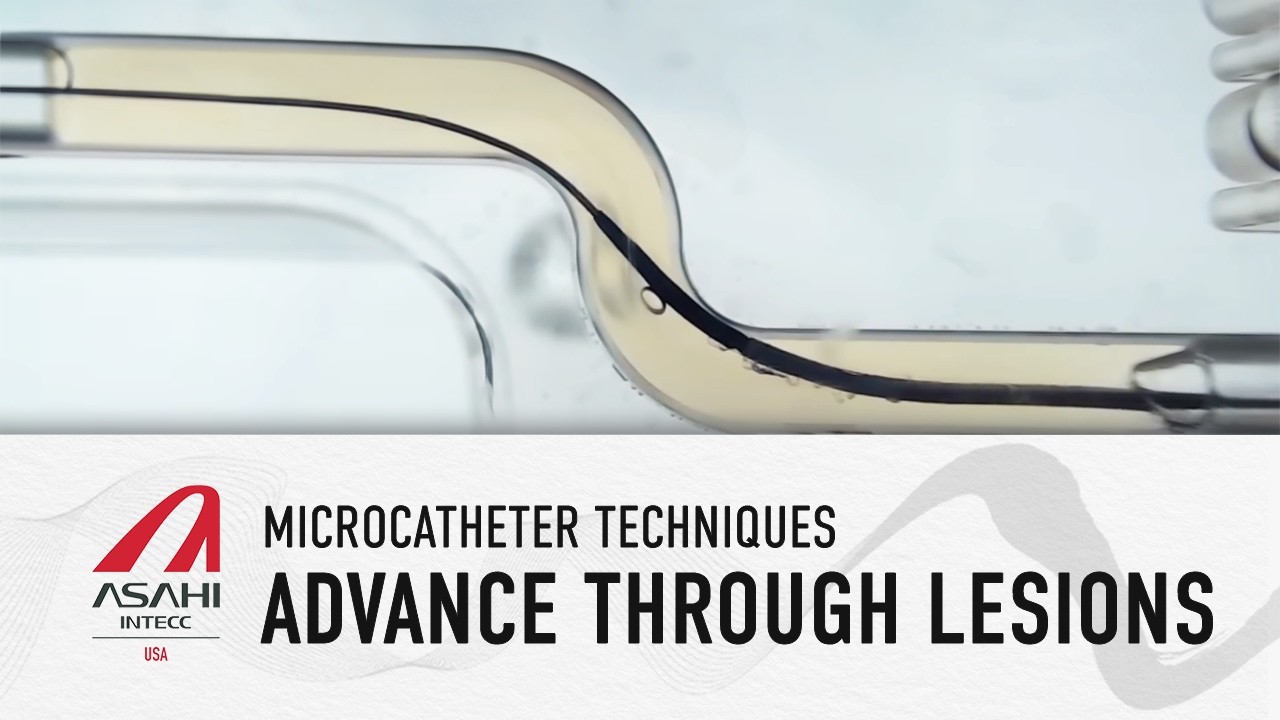 A quick tutorial on advancing your Microcatheter through the lesion.