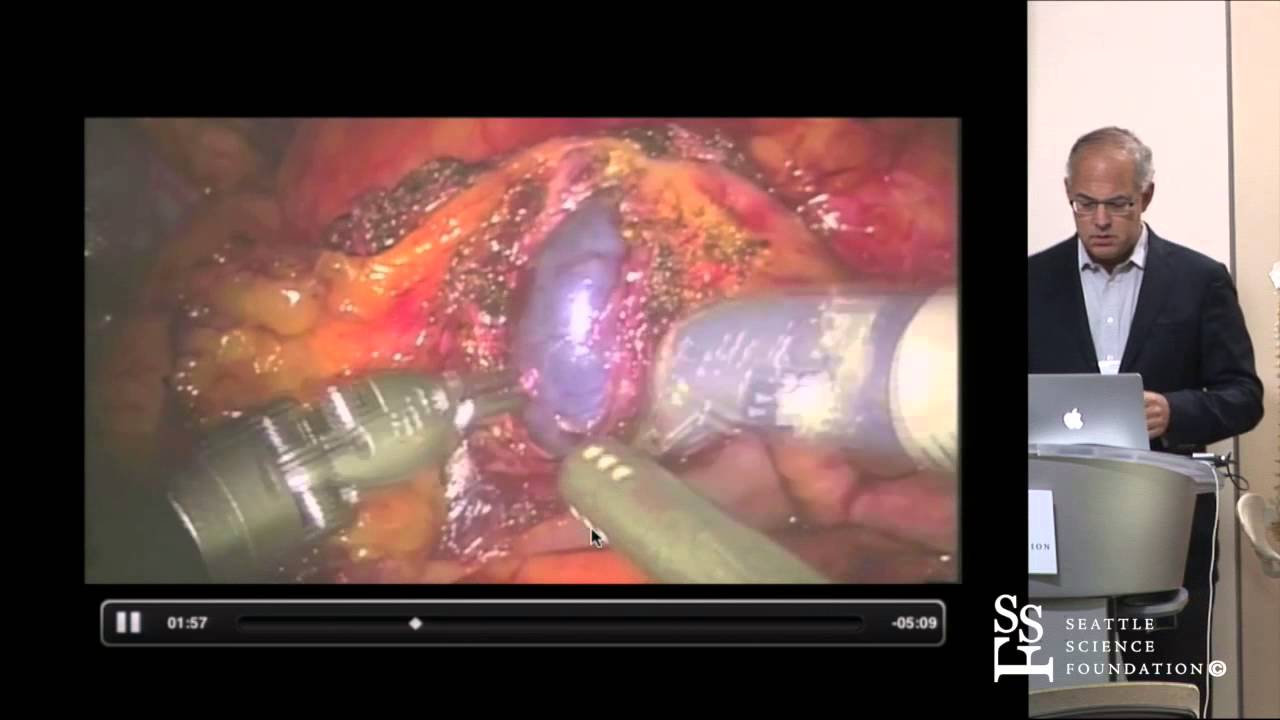 Robotic Distal Ureterectomy, Psoas Hitch and Reimplantation by Michael Stifelman, M.D.