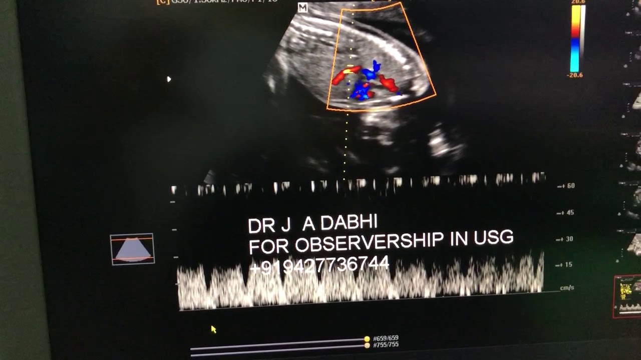 Ductus venosus doppler