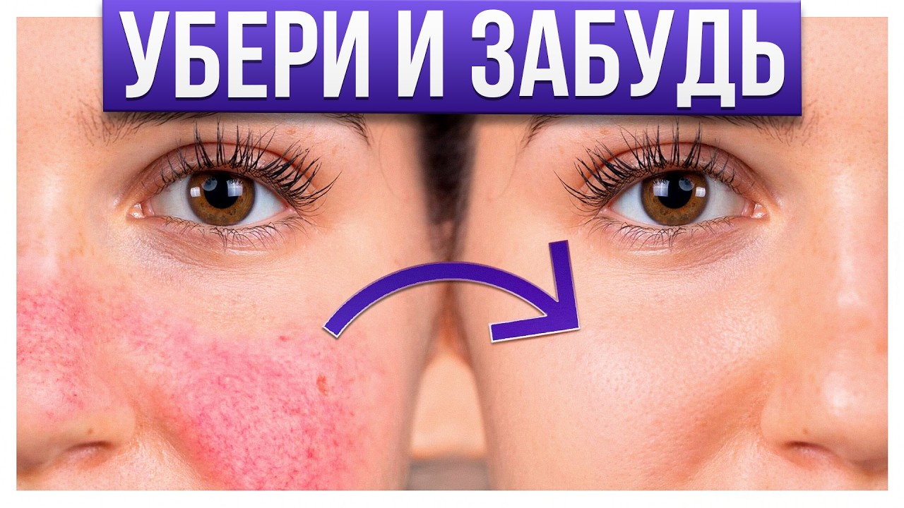 ЭТО поможет ПОБОРОТЬ розацеа! / Как избавиться от РОЗАЦЕА за месяц: Реальные методы лечения