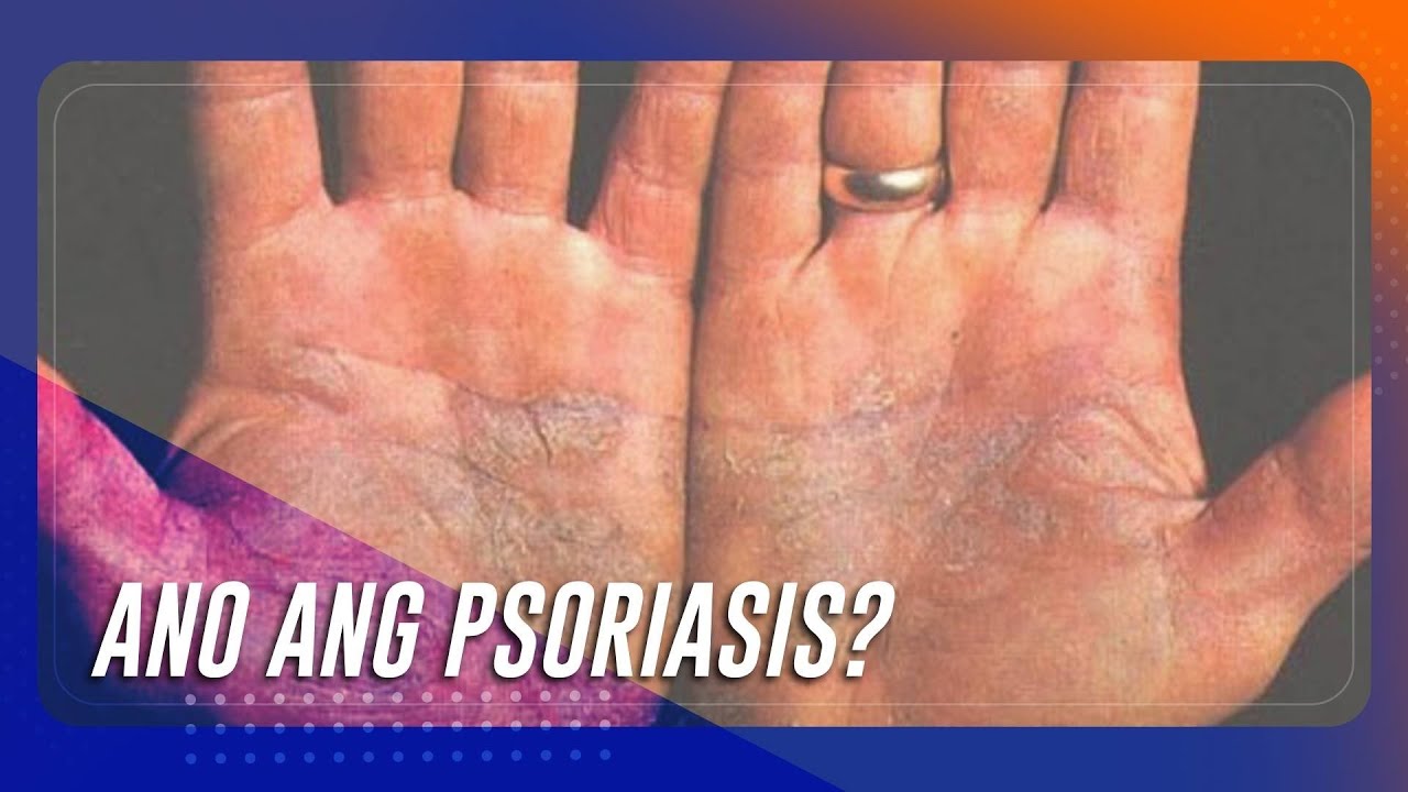 Ano ang psoriasis at paano ito ginagamot? | TeleRadyo Serbisyo