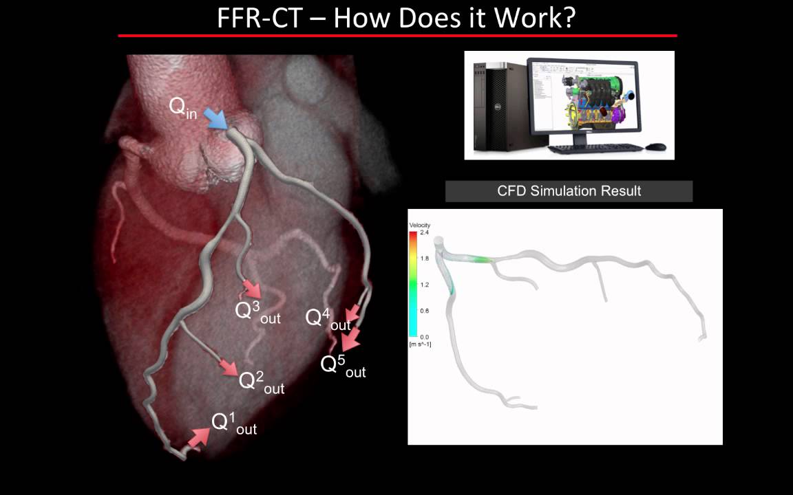 Fractional Flow Reserve Coronary CTA