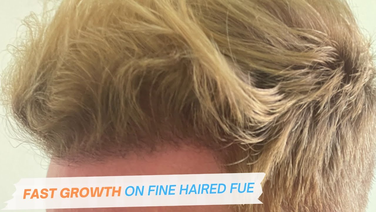 FUE Hair Transplant Result| Impressive Fast Growth Fine Blond Hair Transplant Comb-Through