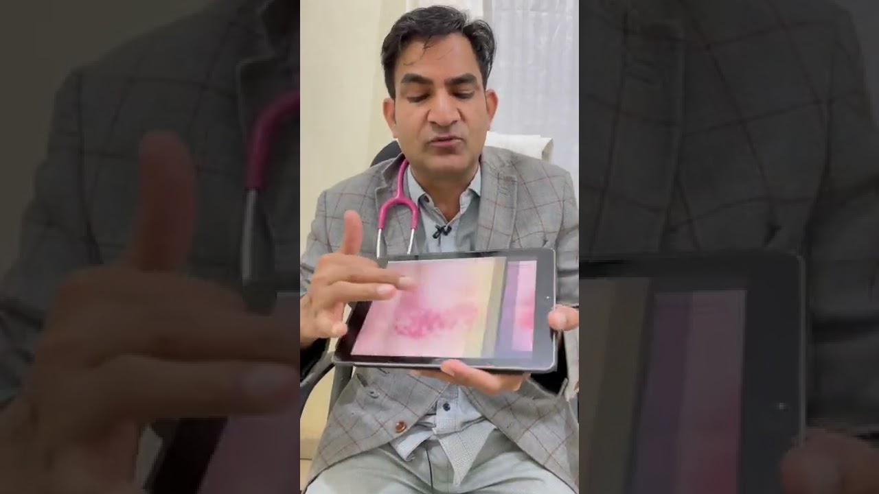 Lip smacking#contact dermatitis#होठ फटना