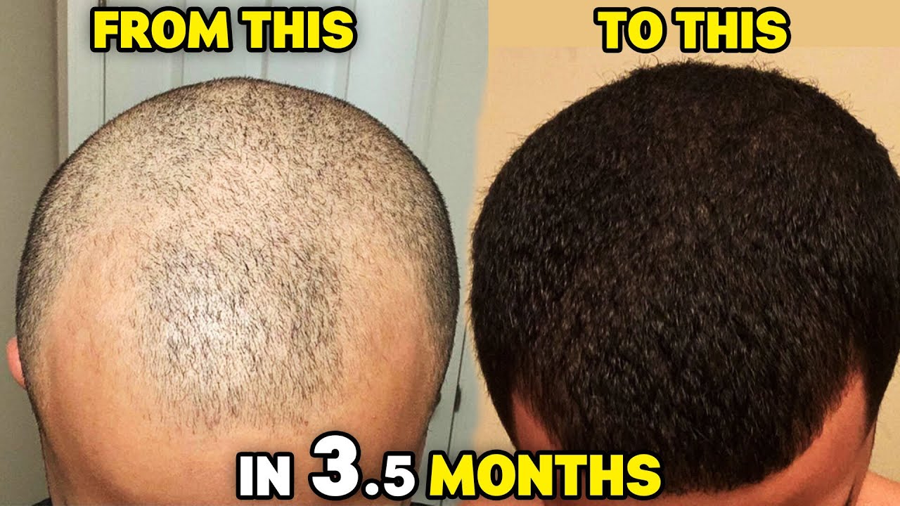 The Big 3 Hair Loss Stack HYPER-RESPONDER INSANE 3.5 Month Results