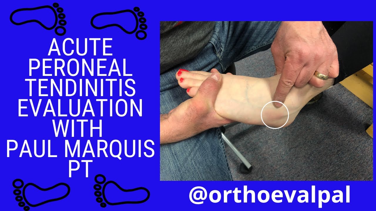 Acute Peroneal Tendinitis Evaluation with @OrthoEvalPal