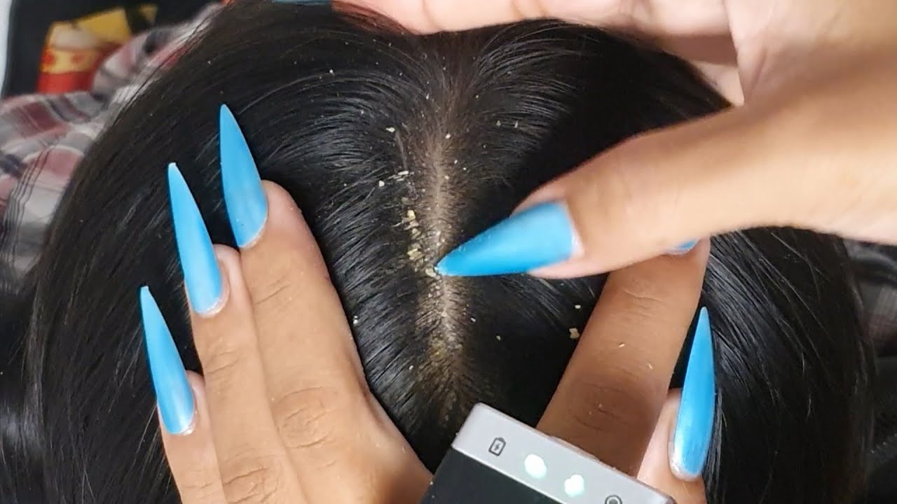 Dry Scalp Tingle Therapy ASMR 💆&zwj;♀️✨ | Close-Up Scratching & Flake Removal #VF0181