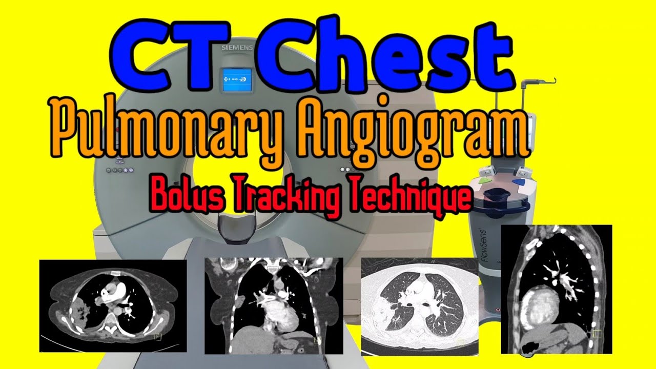 CT Chest Pulmonary Angiogram (Bolus Tracking Technique)