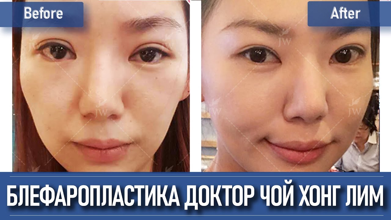 Блефаропластика в Корее - лучший эксперт исправляющий ошибки других хирургов