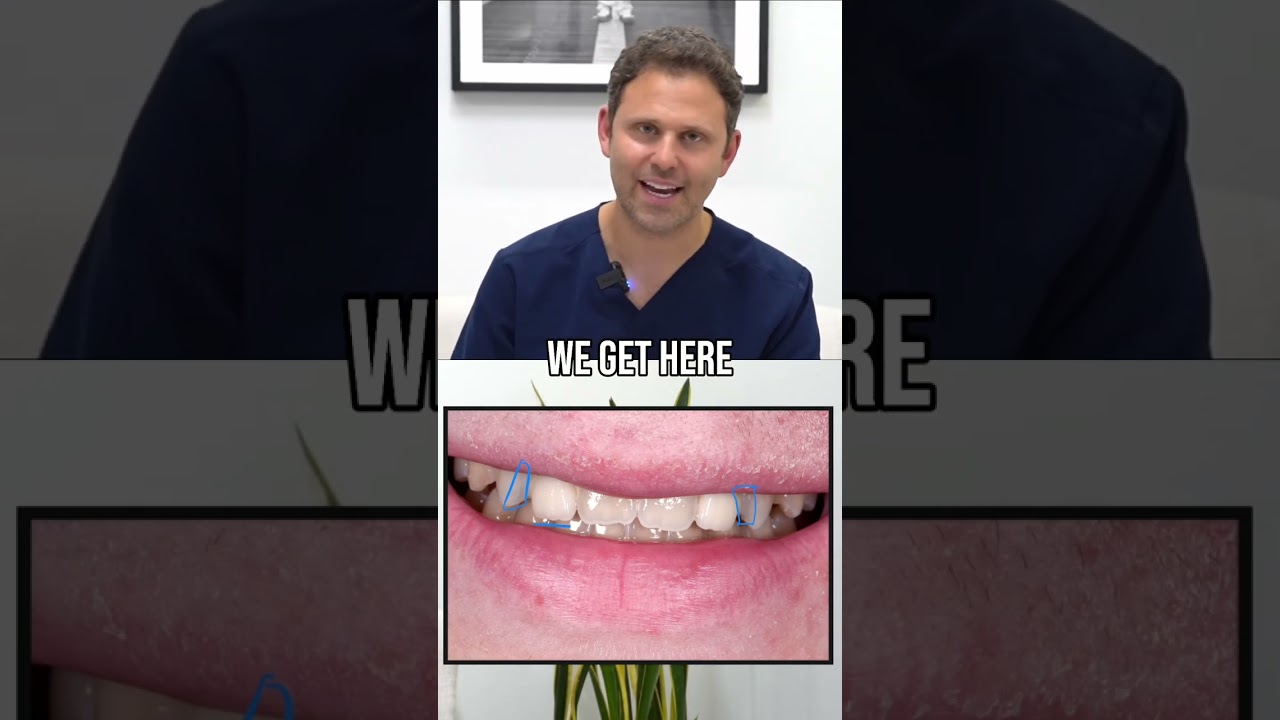 Congenitally Missing Lateral Incisors?