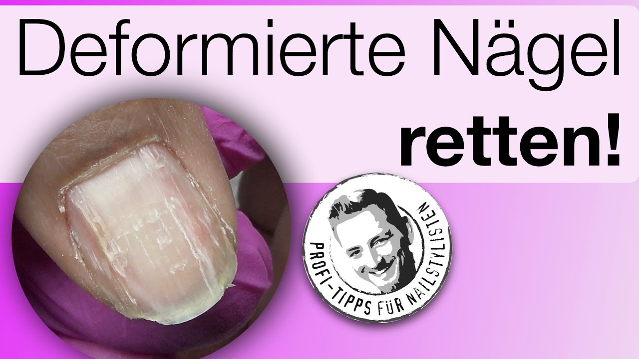 Deformierte Nagelplatte retten mit UV Gel