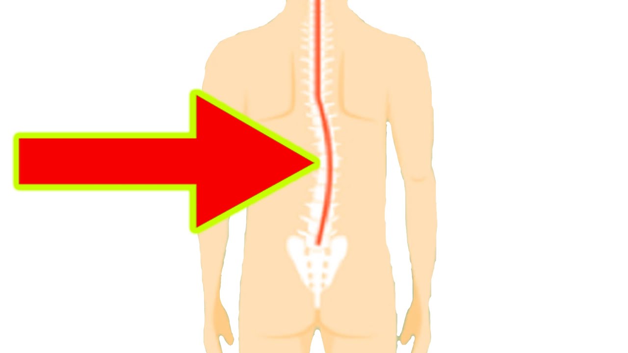 Fix Your Curved Spine (Scoliosis) - 휘어진 척추를 간단하게 교정하는 법