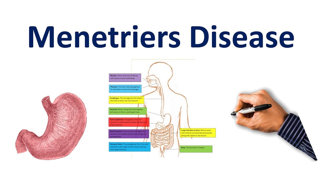 Menetriers Disease Made Easy:  USMLE Step 1, NCLEX, COMLEX