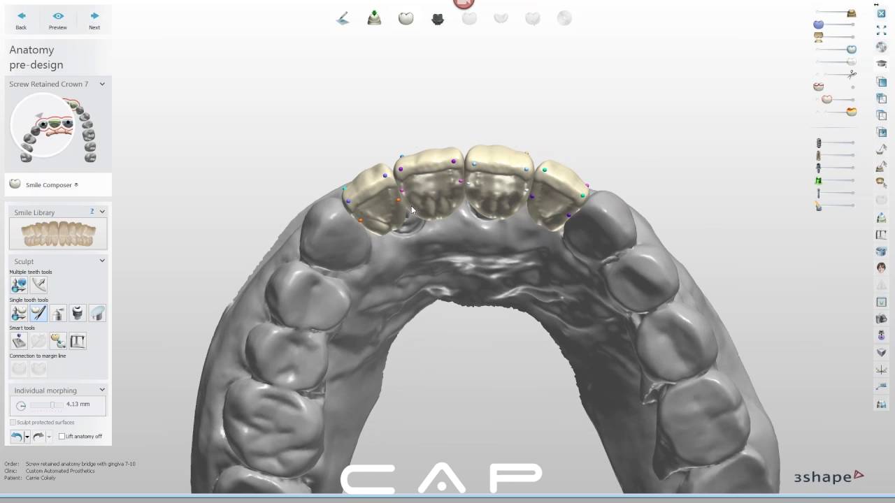 Designing an Izir Bridge in 3Shape, with Carrie Cokely, Senior CAD Technician