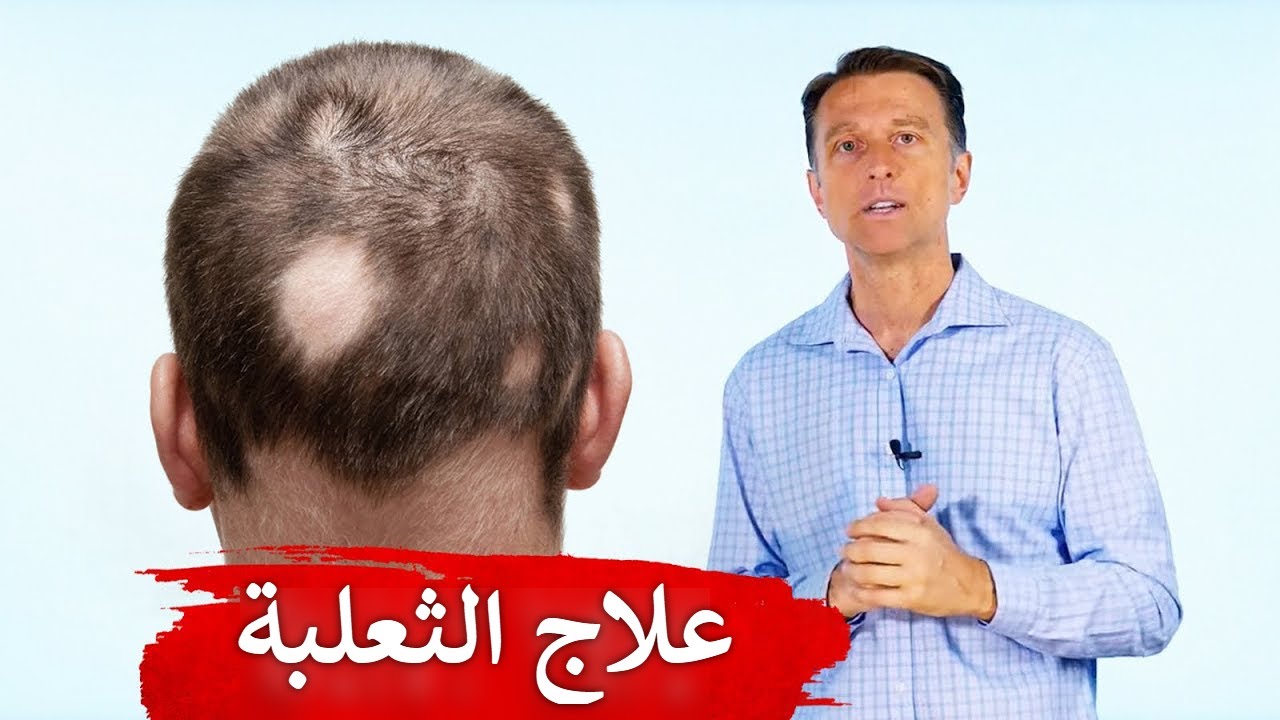علاج بسيط وفعال جدا لتساقط الشعر الموضعي (الثعلبة)