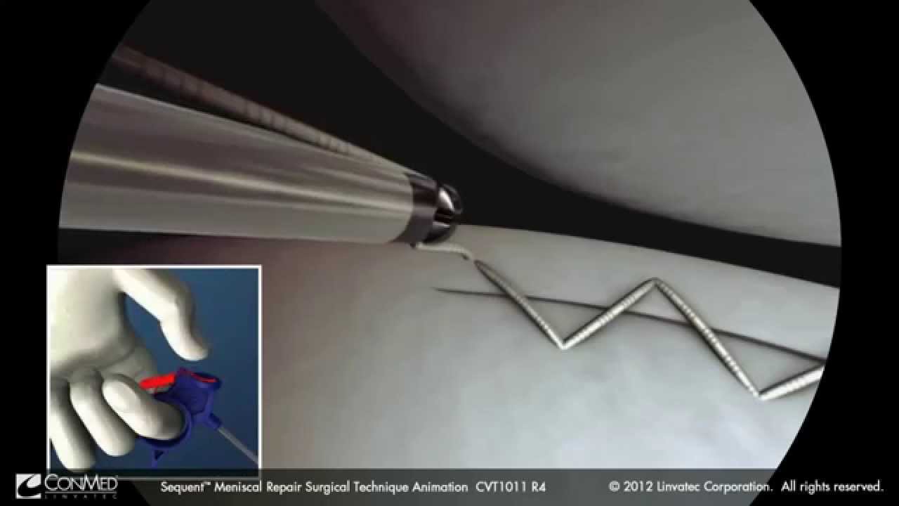 Sequent Surgical Technique video