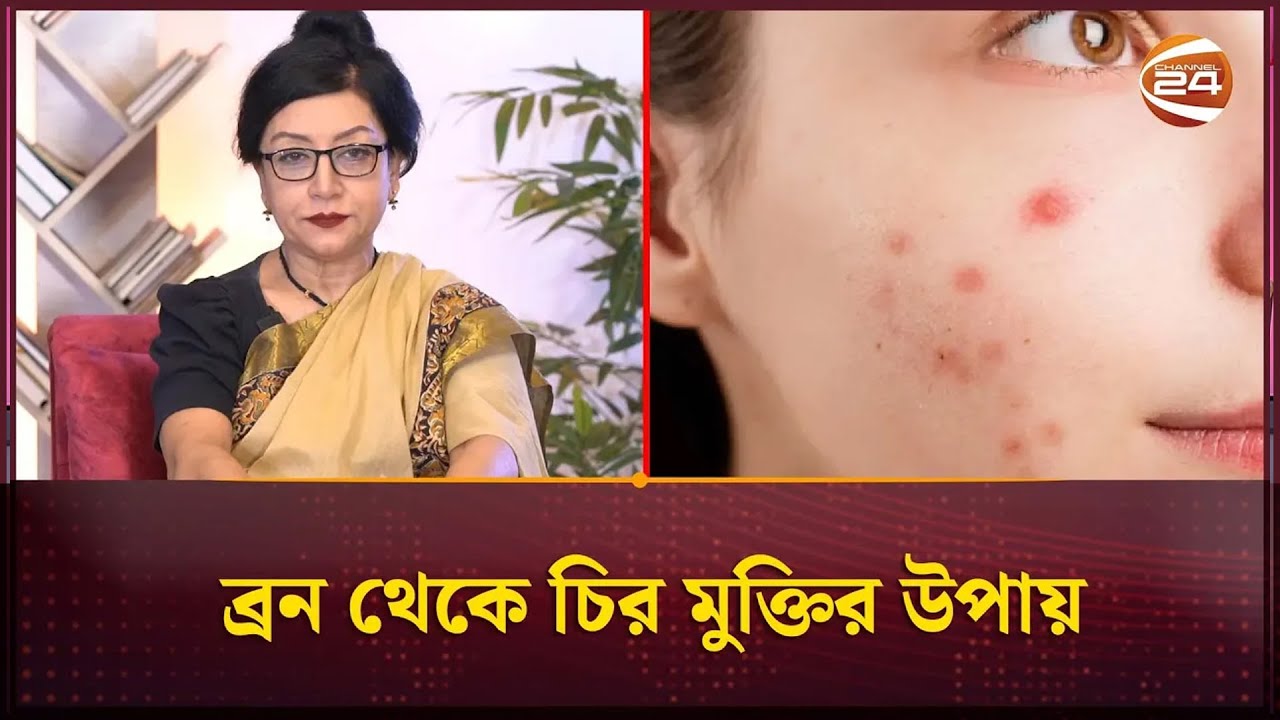 ব্রন থেকে চির মুক্তির উপায় | Dr. Jakariya | Acne Removing | Channel 24