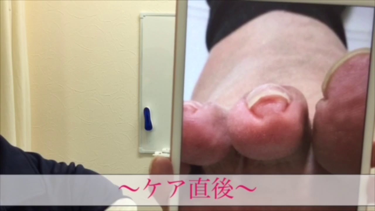 巻き爪 漫談風