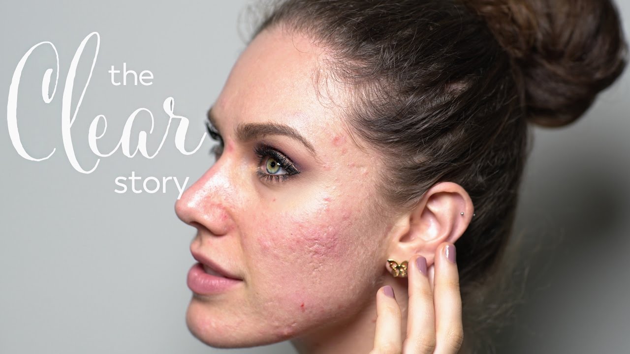 The Clear Story |  Cassandra Bankson and Acne.com