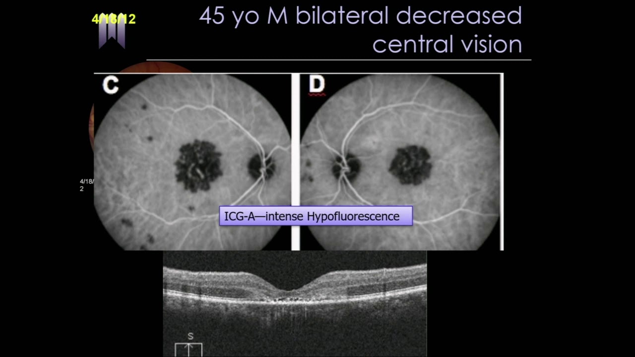 SYM39 09   White Dot Syndromes A Systematic Approach to Diagnosis   Indocyanine Green Angiography