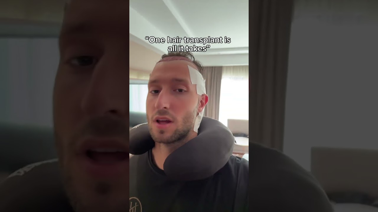 CRAZY HAIR TRANSPLANT RESULTS