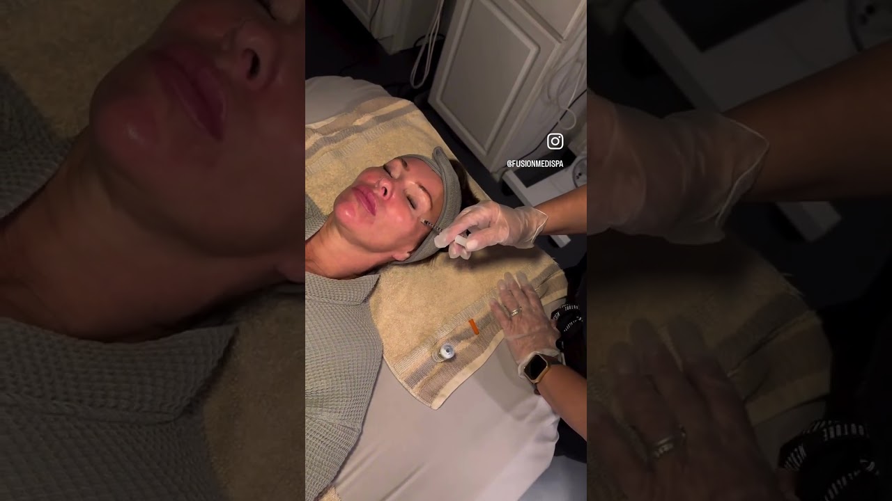 No-Downtime Renew Peel Glow | Fusion Medispa Tampa
