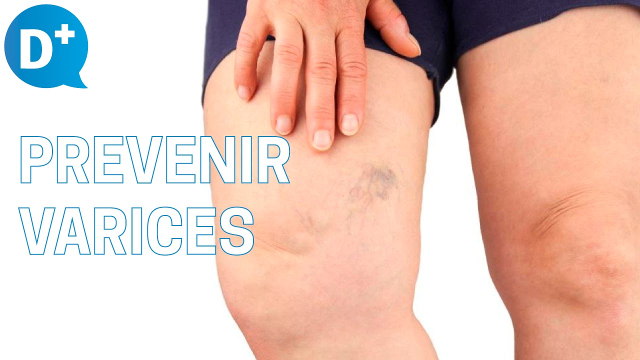 ¿Podemos prevenir la aparición de varices? ¿Cómo?