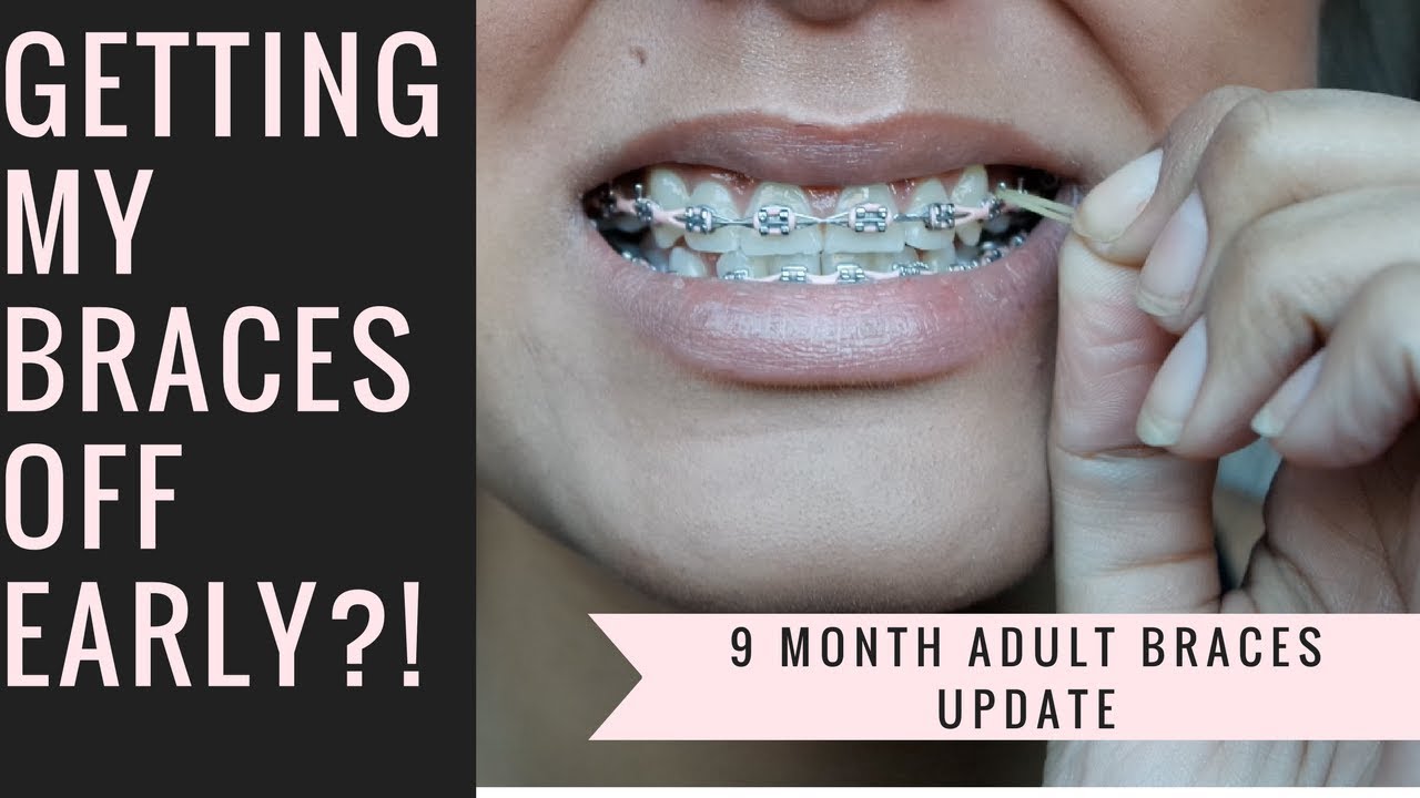 9 Month Adult Braces Update: Getting My Braces Off Early?!