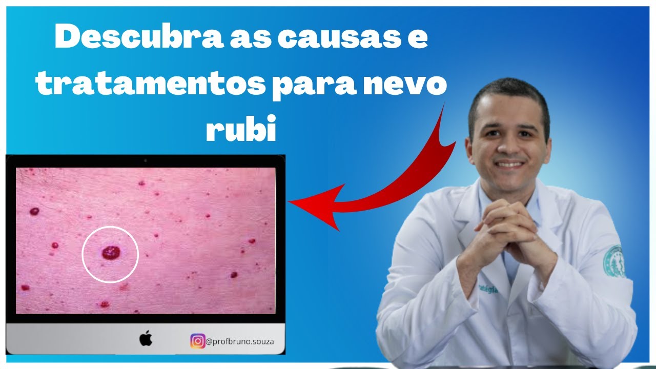 Como tratar e prevenir bolinhas vermelhas na pele (angioma rubi) - Conselhos de um dermatologista