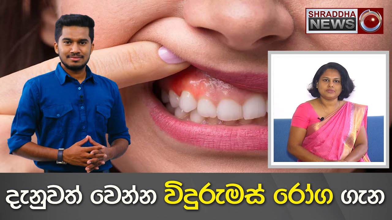 දැනුවත් වෙන්න විදුරුමස් රෝග ගැන - ඩොක්ටගෙන් අහන්න&hellip;(2022-12-25)