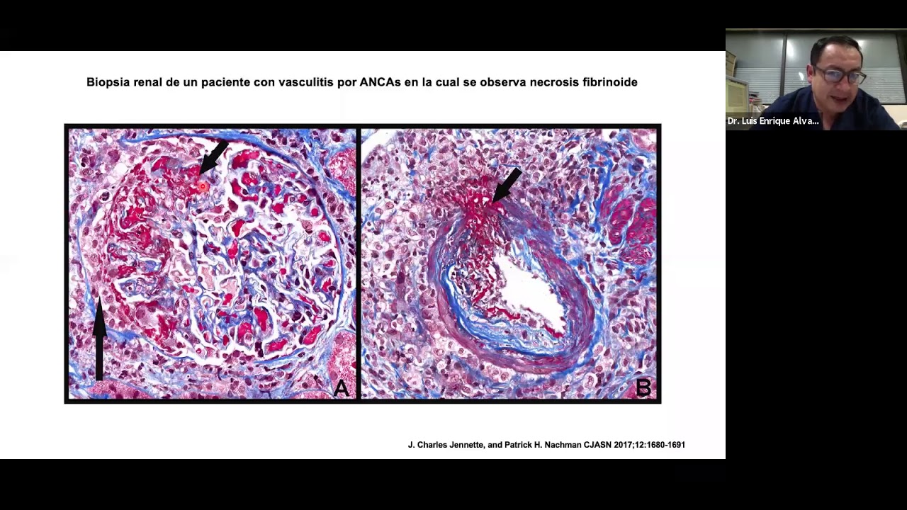 Vasculitis Asociada a #ANCAs