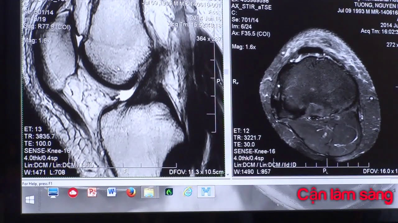 HƯỚNG DẪN THỰC HÀNH ĐỌC PHIM MRI KHỚP GỐI | BS. PHAN CHÂU HÀ