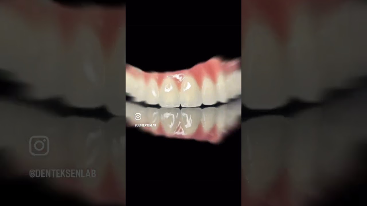 İmplant Destekli Sabit Protez:&Ccedil;ene kemiğine yerleştirilen dental implantlar &uuml;zerine yapılan protez.