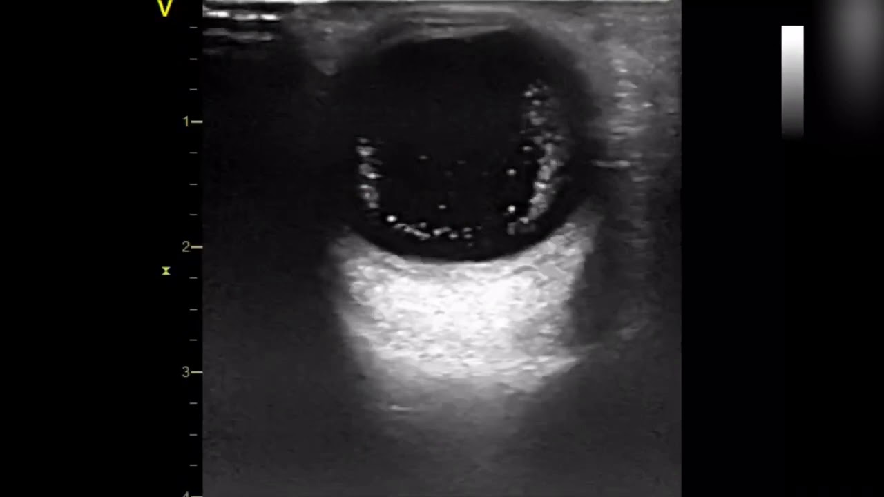 Touch in shift 👋 Asteroid Hyalosis. #POCUS